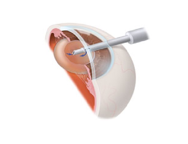 Phacoemulsification